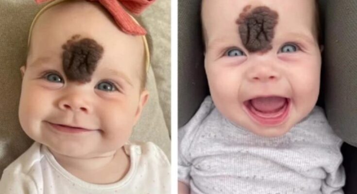 Her Parents Chose to Remove Her Birthmark to Keep Her Safe — Here’s What She Looks Like Years Later…
