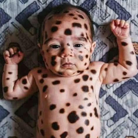 After laying eyes on his newborn baby, this father fell silent. In the end, all he could mutter is “it’s bad”. Yet he and his wife pulled themselves together, giving their little bundle of joy all the love and care she could ever need. Sit down and brace yourself before you see how she looks today at 5 years old