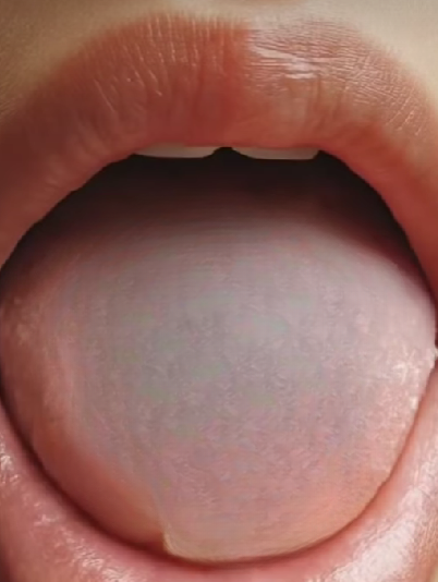 Why Does the Tongue Turn White? Viral Video Sparks Laughter, But Doctors Explain the Real Reasons